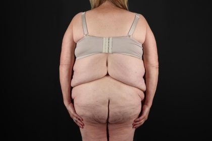 Fleur De Lis Circumferential Body Lift Before & After Patient #9286