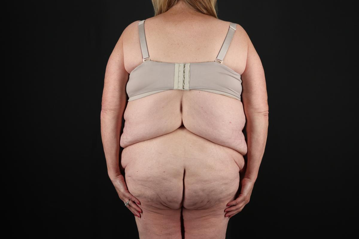 Fleur De Lis Circumferential Body Lift Before & After Patient #9286