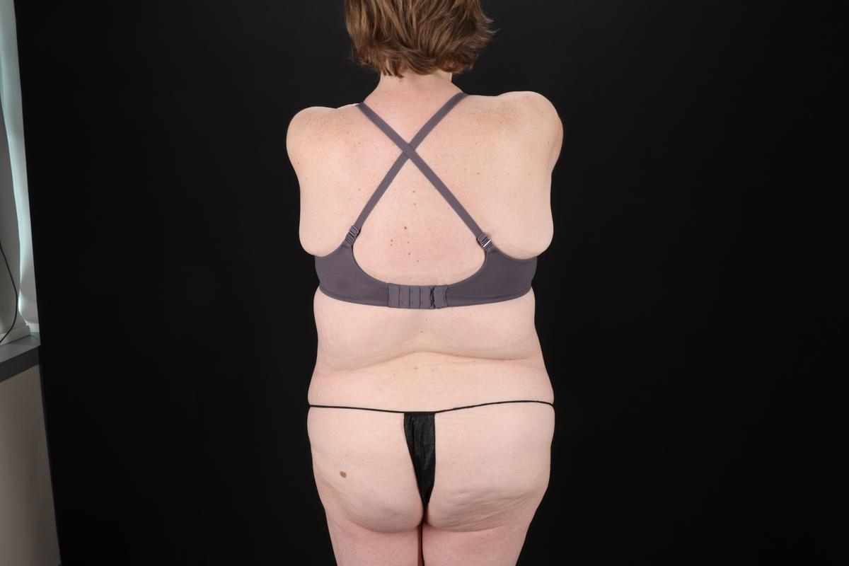 Fleur De Lis Tummy Tuck Before & After Patient #9506