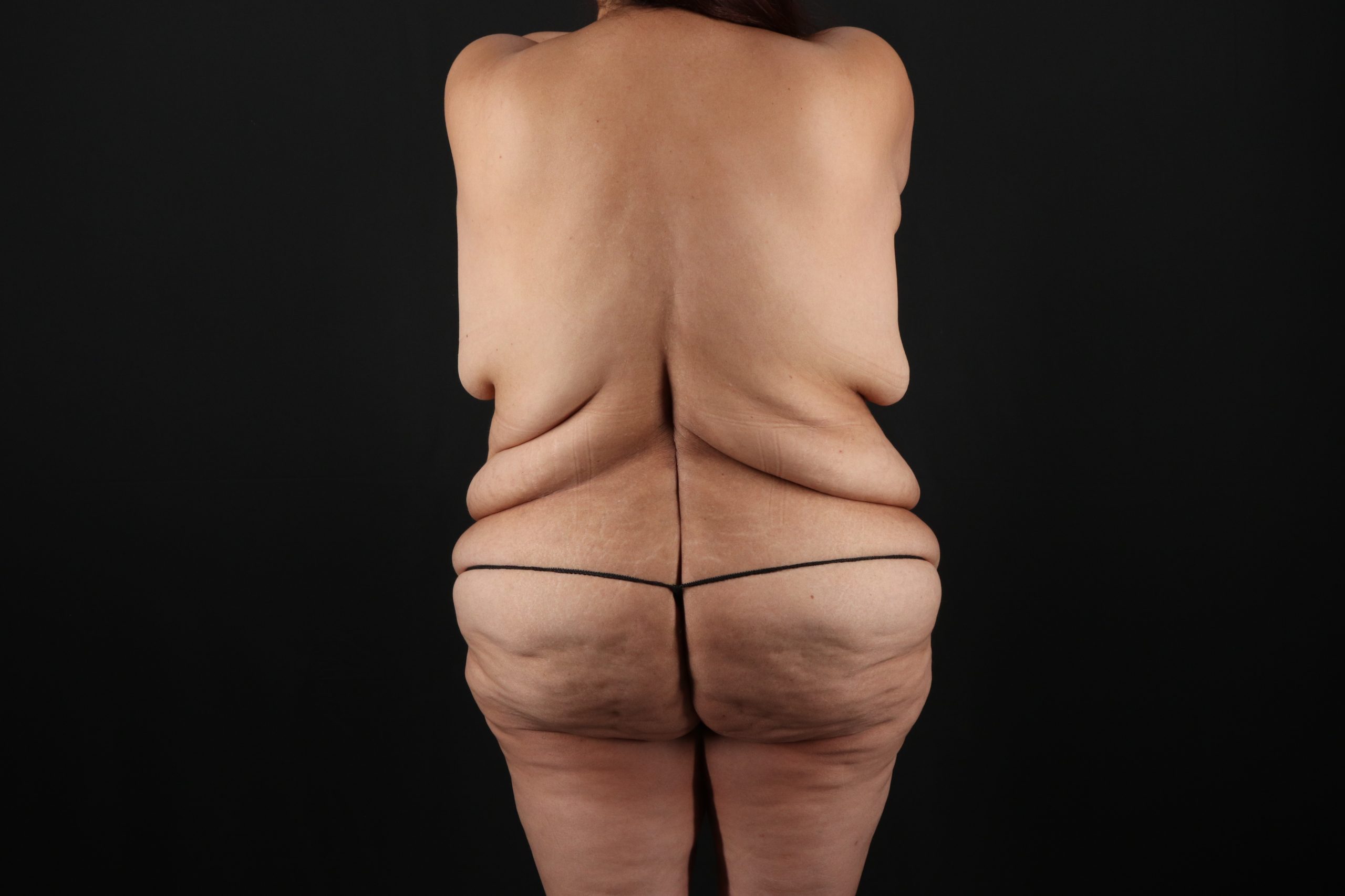 Fleur De Lis Circumferential Body Lift Before & After Patient #9278
