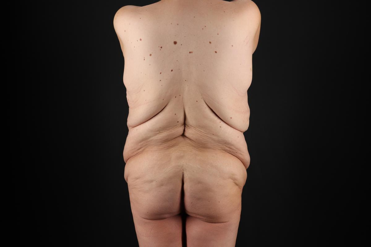 Fleur De Lis Circumferential Body Lift Before & After Patient #9287