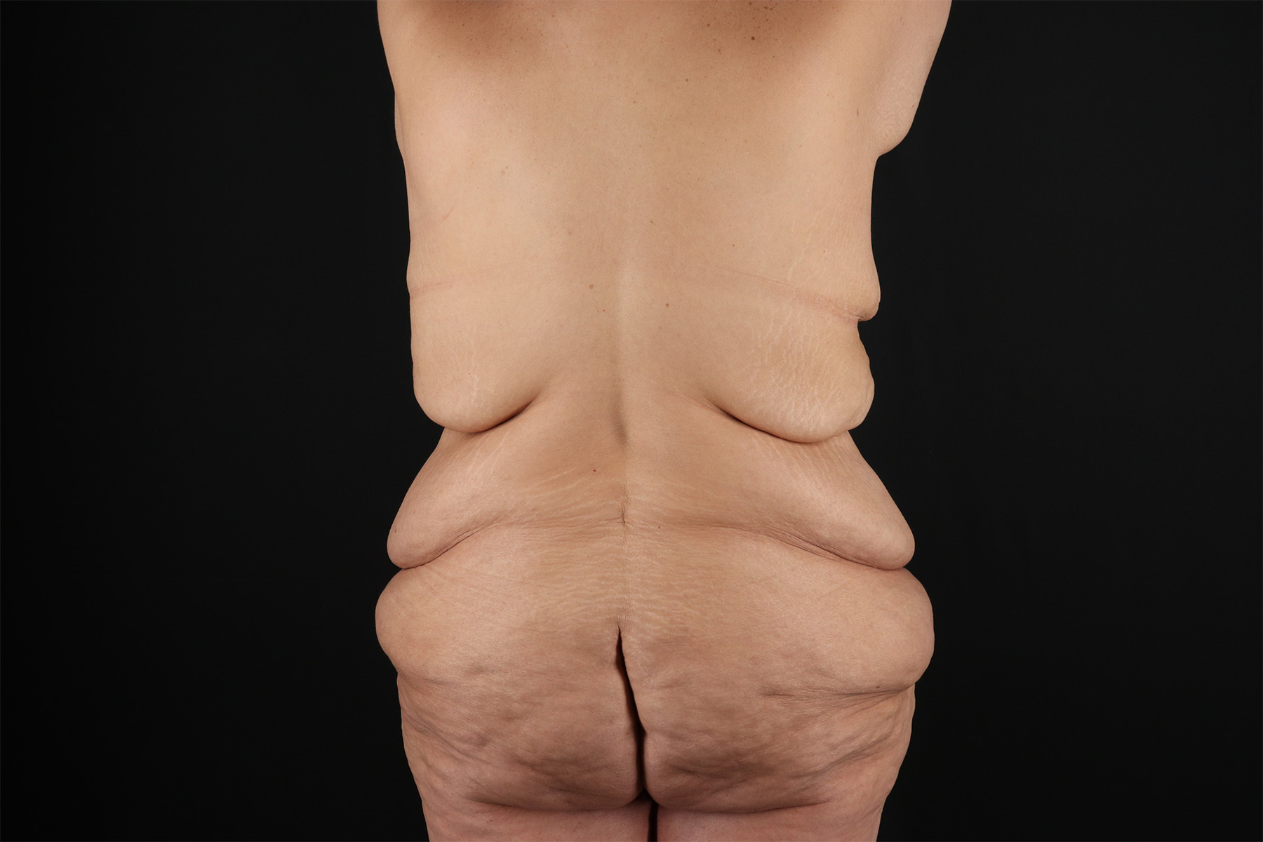 Fleur De Lis Tummy Tuck Before & After Patient #9509