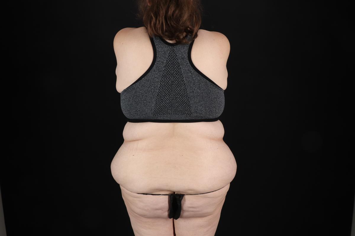 Fleur De Lis Circumferential Body Lift Before & After Patient #9284