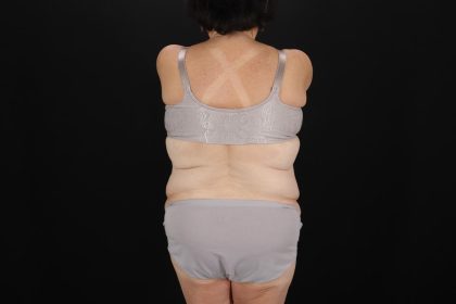 Fleur De Lis Tummy Tuck Before & After Patient #9507