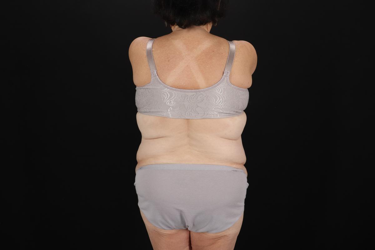 Fleur De Lis Tummy Tuck Before & After Patient #9507