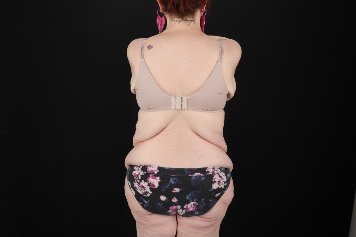 Fleur De Lis Circumferential Body Lift Before & After Patient #9283