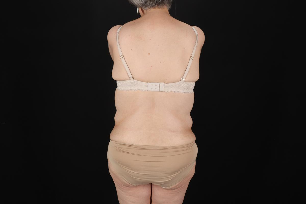 Fleur De Lis Circumferential Body Lift Before & After Patient #9328