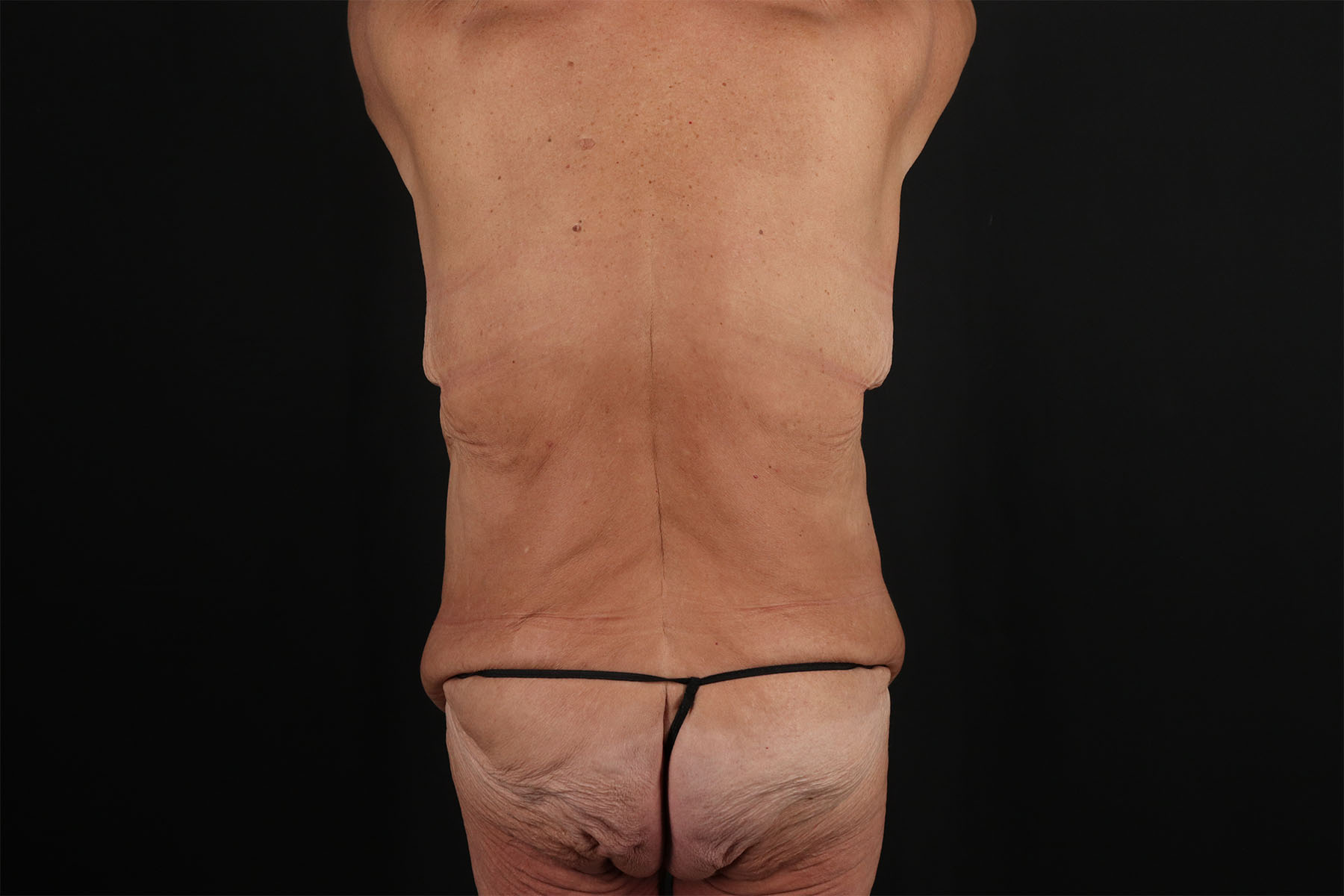 Fleur De Lis Circumferential Body Lift Before & After Patient #9281