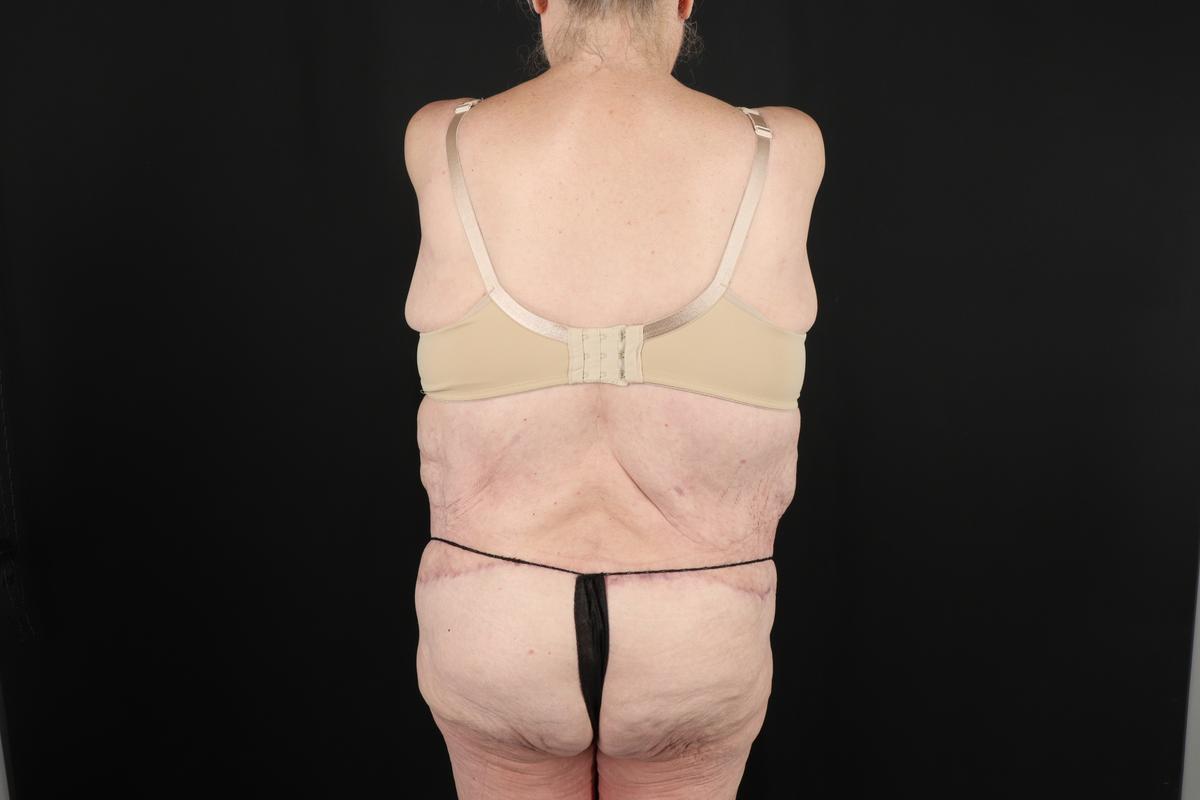 Fleur De Lis Circumferential Body Lift Before & After Patient #9286