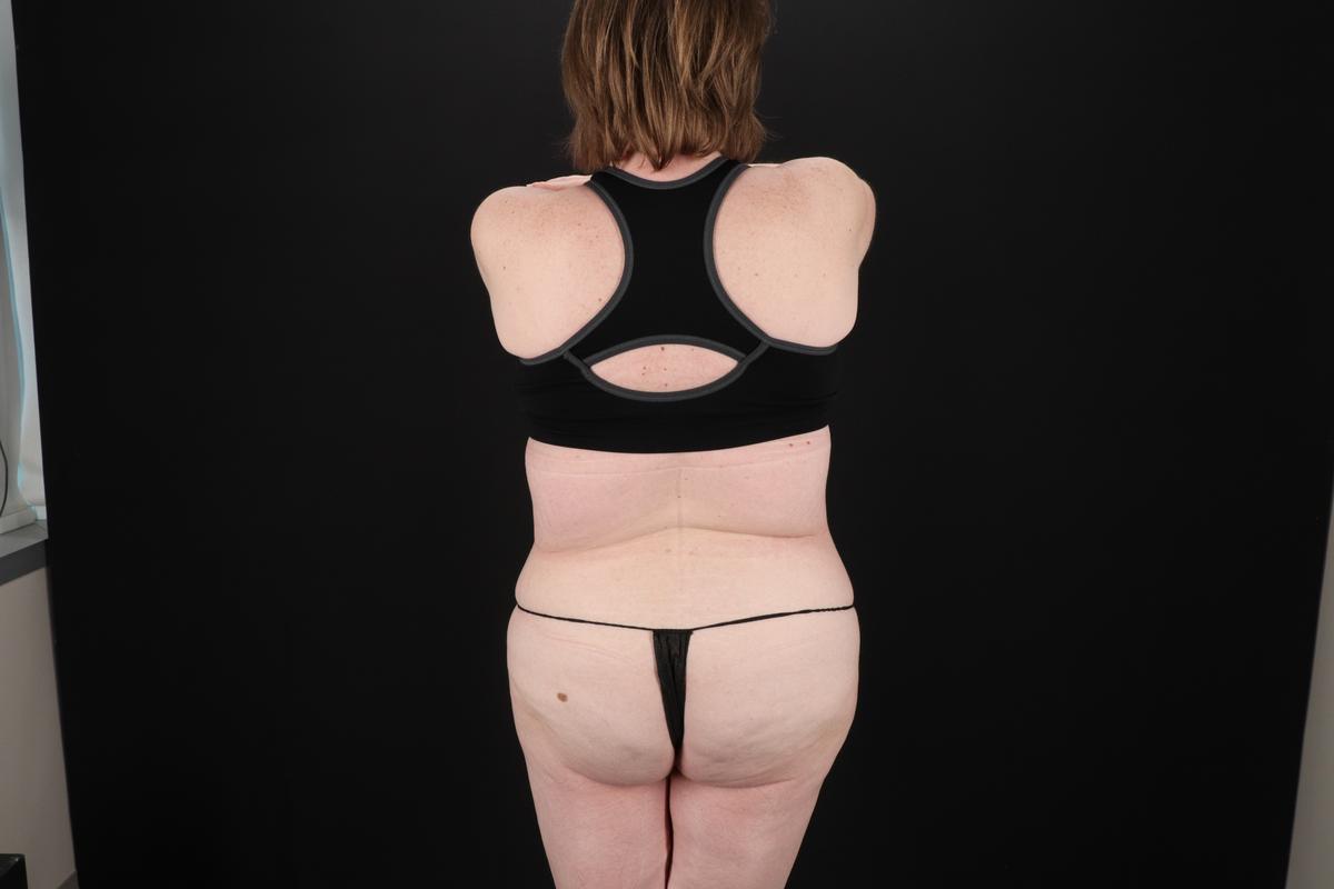 Fleur De Lis Tummy Tuck Before & After Patient #9506