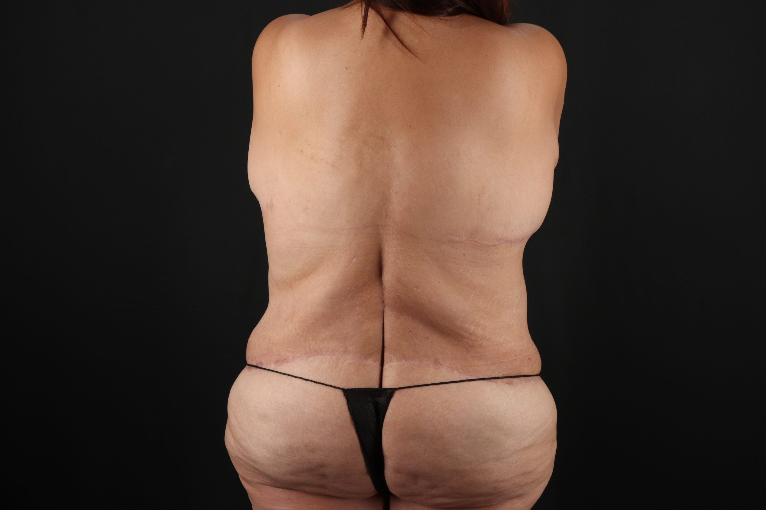Fleur De Lis Circumferential Body Lift Before & After Patient #9278