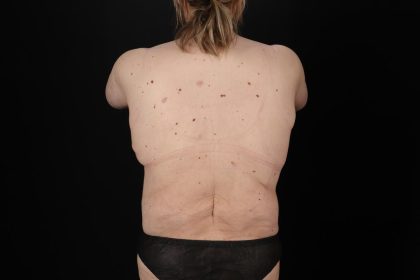 Fleur De Lis Circumferential Body Lift Before & After Patient #9287