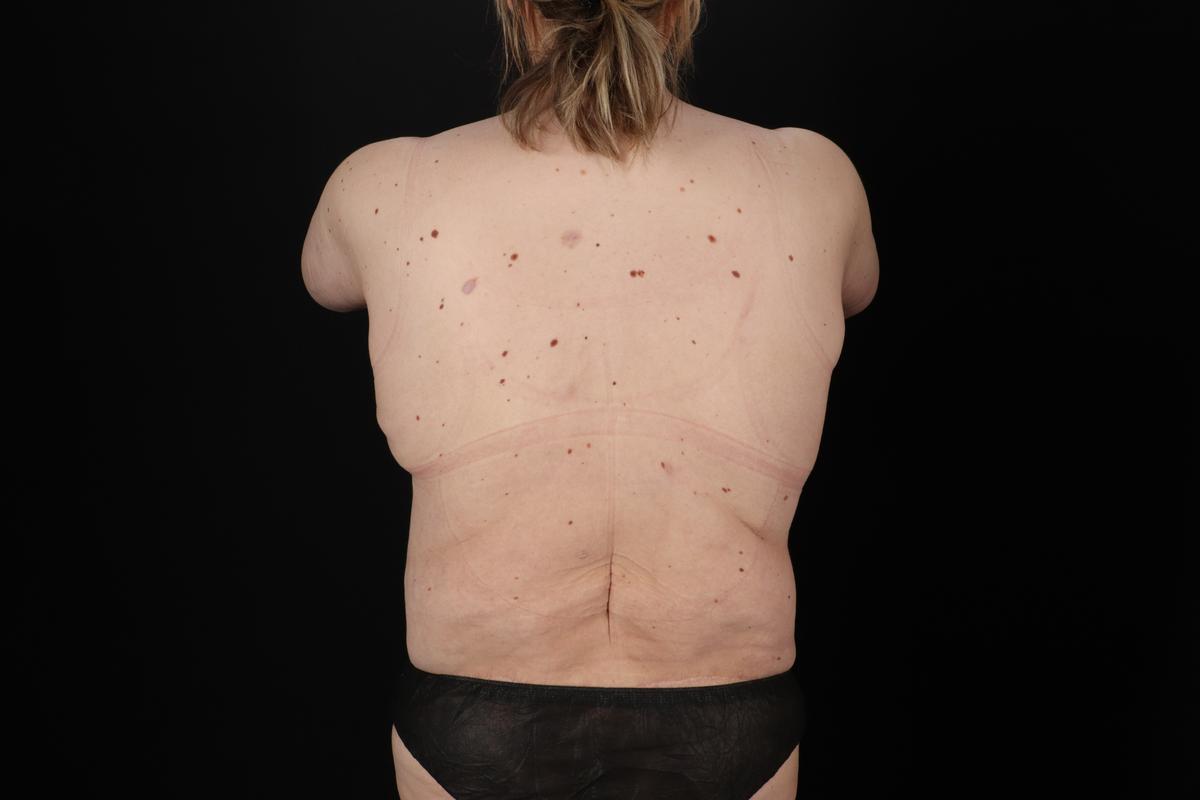 Fleur De Lis Circumferential Body Lift Before & After Patient #9287