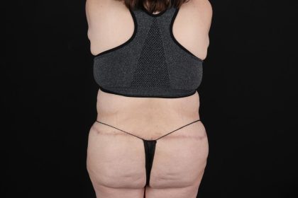 Fleur De Lis Circumferential Body Lift Before & After Patient #9284