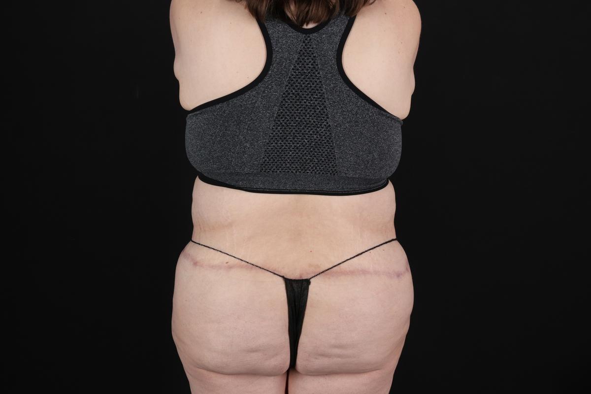 Fleur De Lis Circumferential Body Lift Before & After Patient #9284
