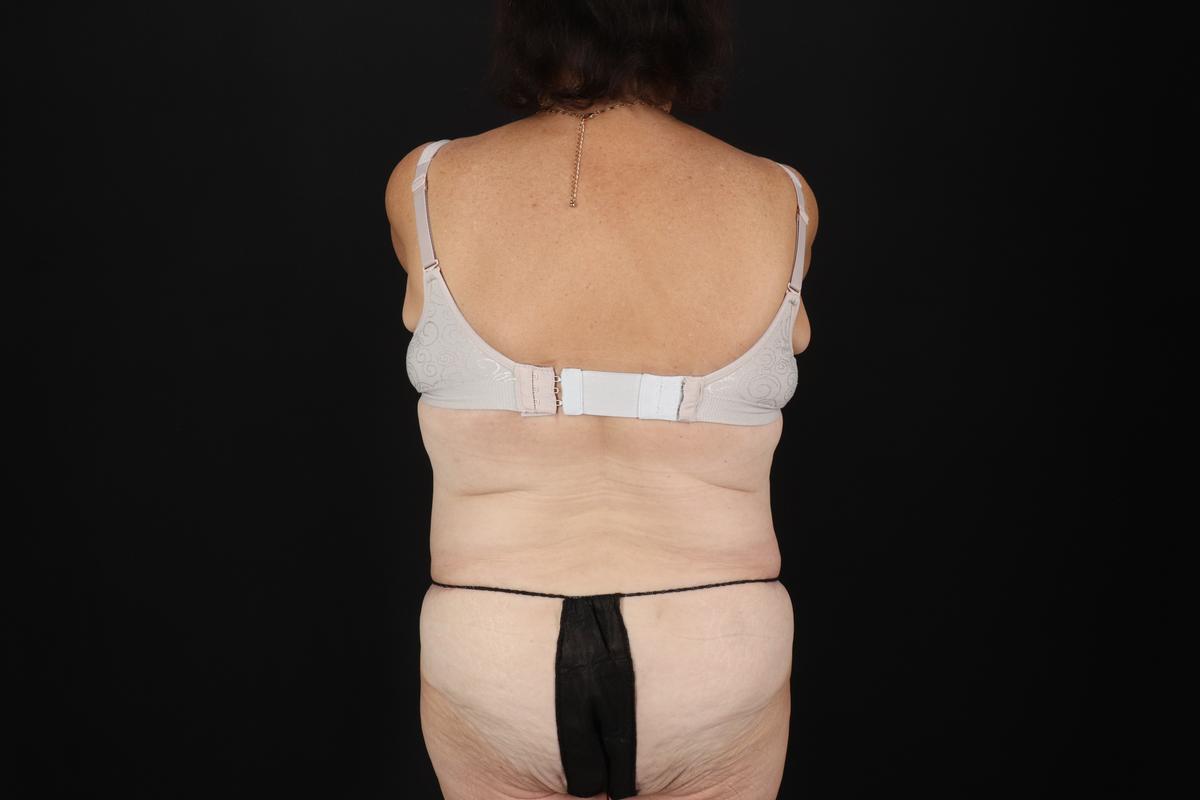 Fleur De Lis Tummy Tuck Before & After Patient #9507