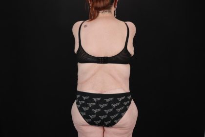 Fleur De Lis Circumferential Body Lift Before & After Patient #9283