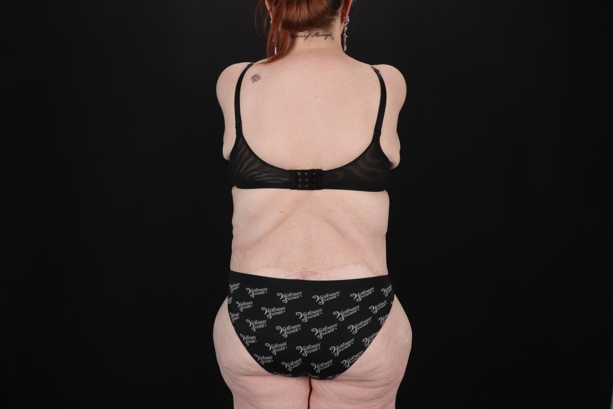 Fleur De Lis Circumferential Body Lift Before & After Patient #9283
