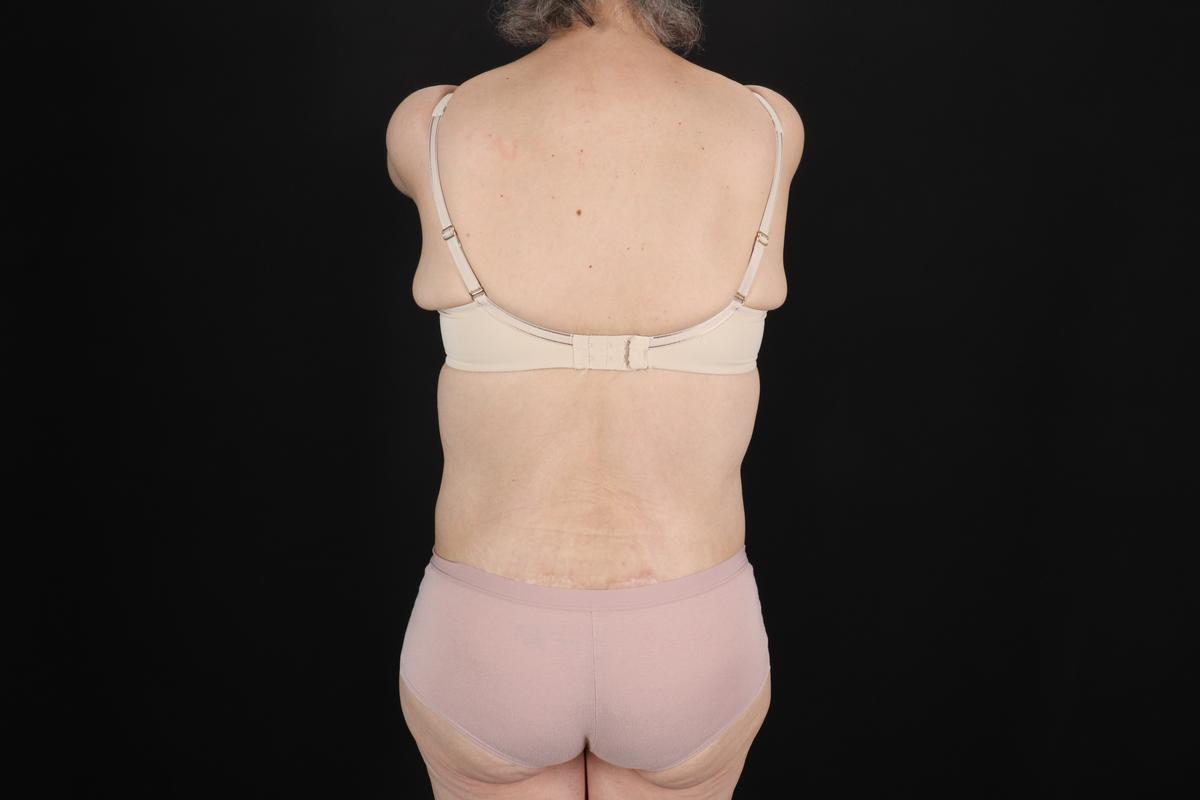 Fleur De Lis Circumferential Body Lift Before & After Patient #9328
