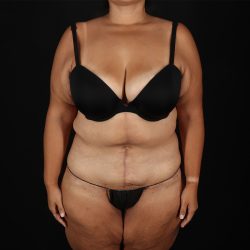 Fleur De Lis Tummy Tuck Before & After Patient #9508