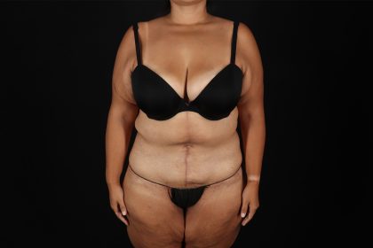 Fleur De Lis Tummy Tuck Before & After Patient #9508
