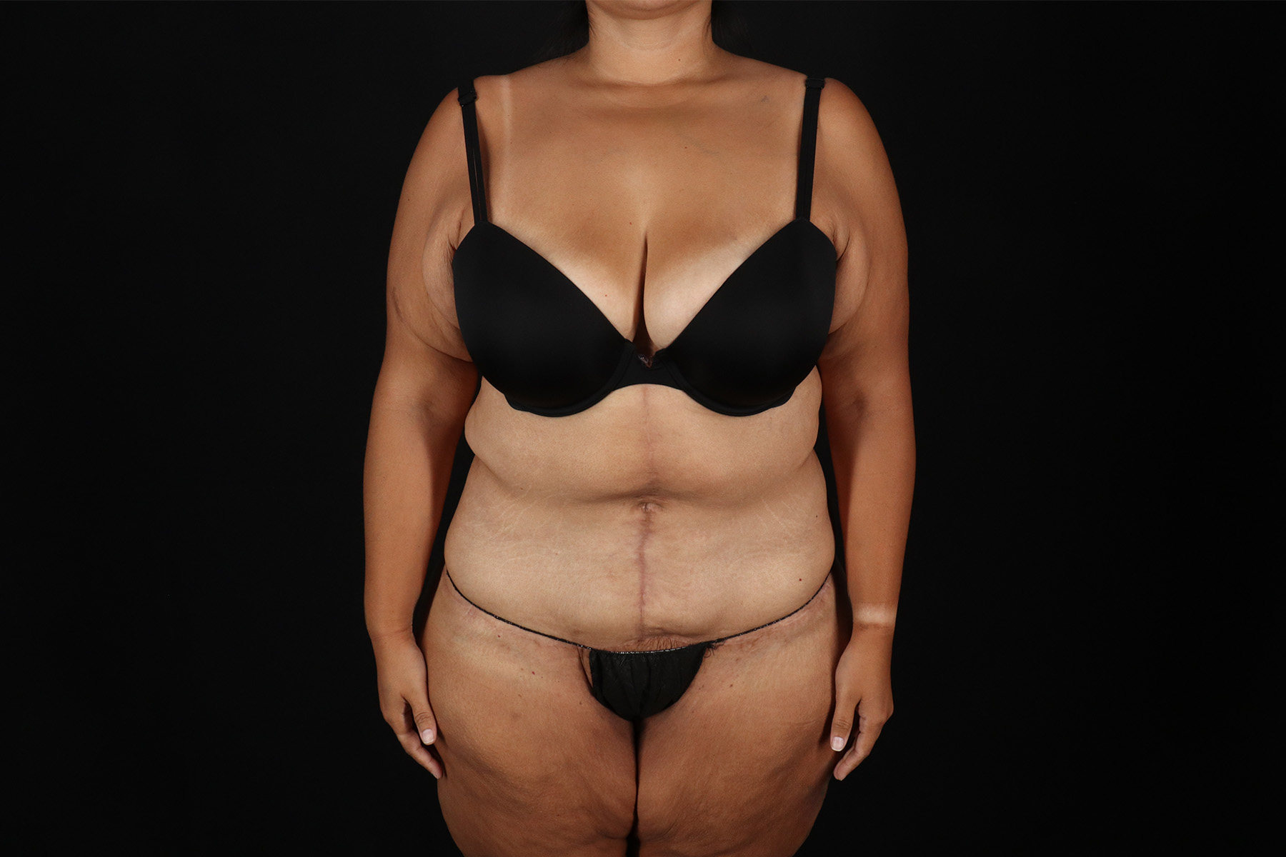 Fleur De Lis Tummy Tuck Before & After Patient #9508