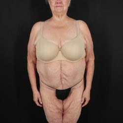 Fleur De Lis Circumferential Body Lift Before & After Patient #9286