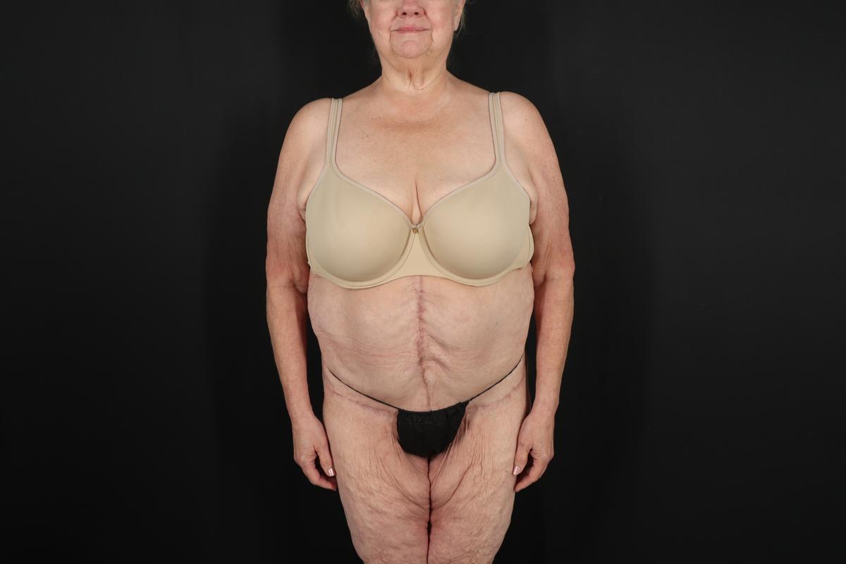 Fleur De Lis Circumferential Body Lift Before & After Patient #9286