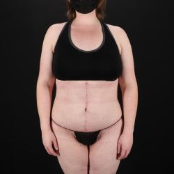 Fleur De Lis Tummy Tuck Before & After Patient #9506