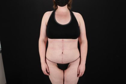 Fleur De Lis Tummy Tuck Before & After Patient #9506