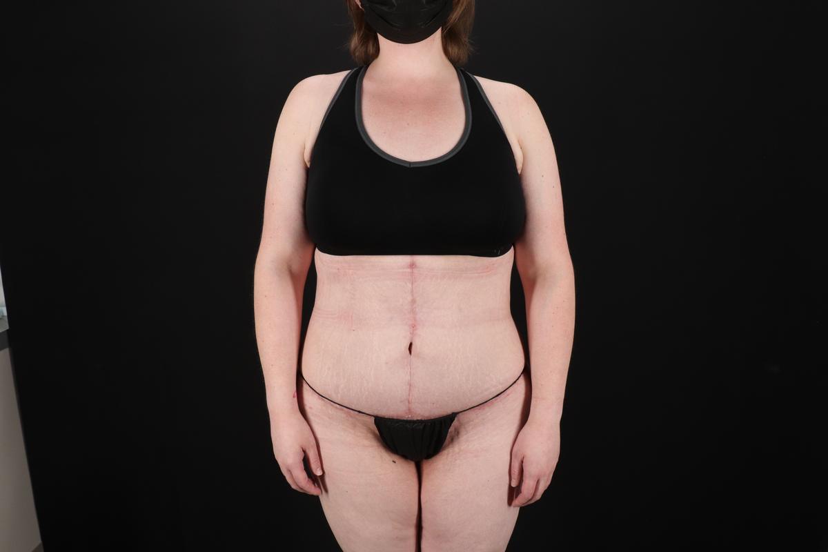 Fleur De Lis Tummy Tuck Before & After Patient #9506