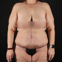 Fleur De Lis Tummy Tuck Before & After Patient #9509