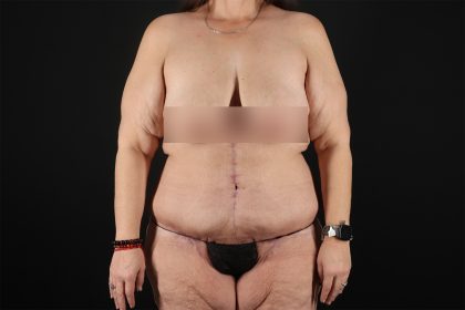 Fleur De Lis Tummy Tuck Before & After Patient #9509