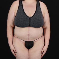 Fleur De Lis Circumferential Body Lift Before & After Patient #9284