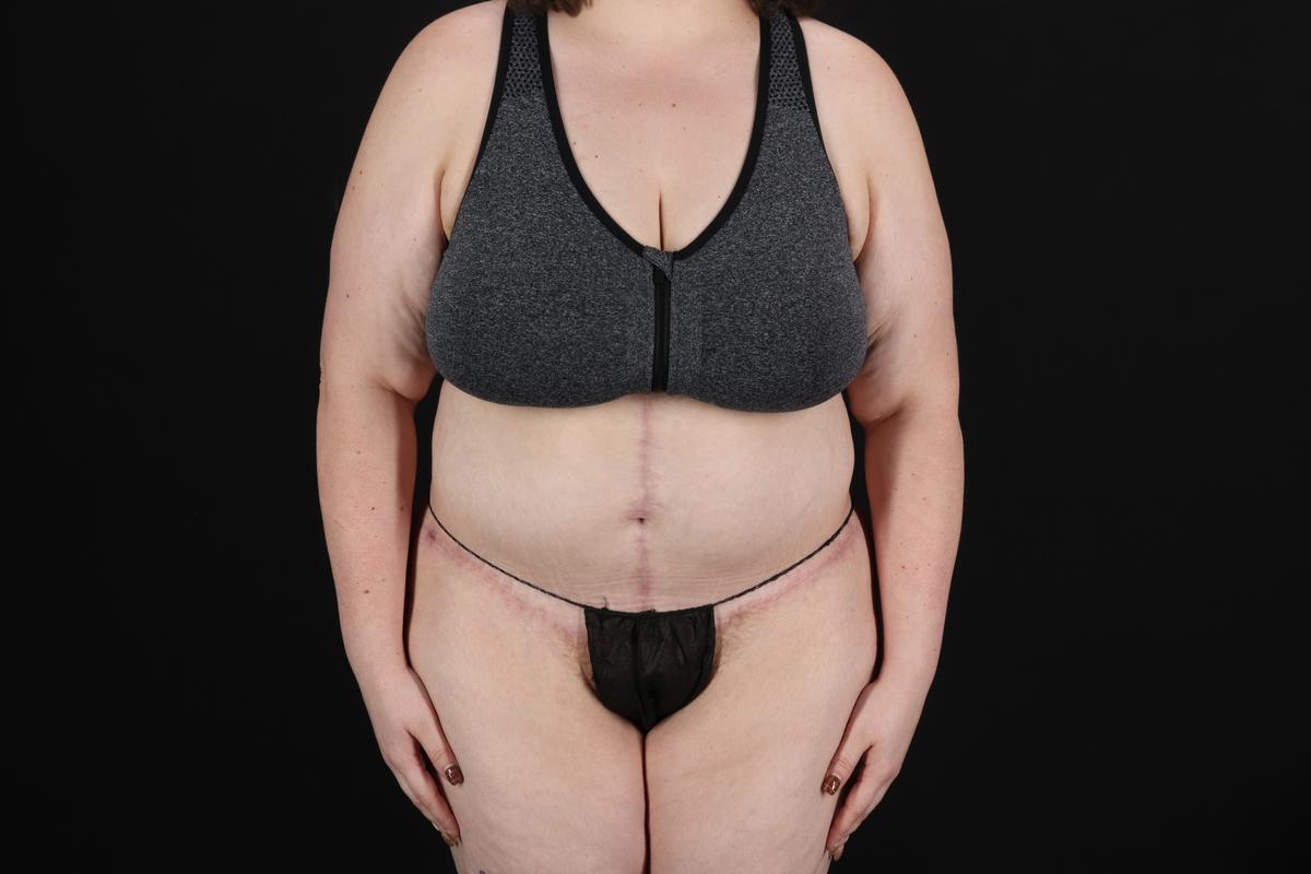 Fleur De Lis Circumferential Body Lift Before & After Patient #9284