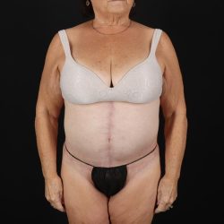 Fleur De Lis Tummy Tuck Before & After Patient #9507