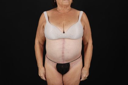 Fleur De Lis Tummy Tuck Before & After Patient #9507