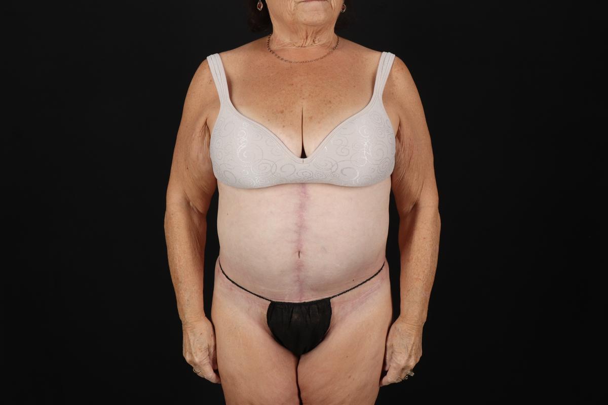 Fleur De Lis Tummy Tuck Before & After Patient #9507