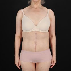 Fleur De Lis Circumferential Body Lift Before & After Patient #9328