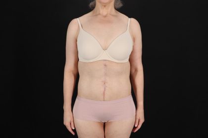 Fleur De Lis Circumferential Body Lift Before & After Patient #9328