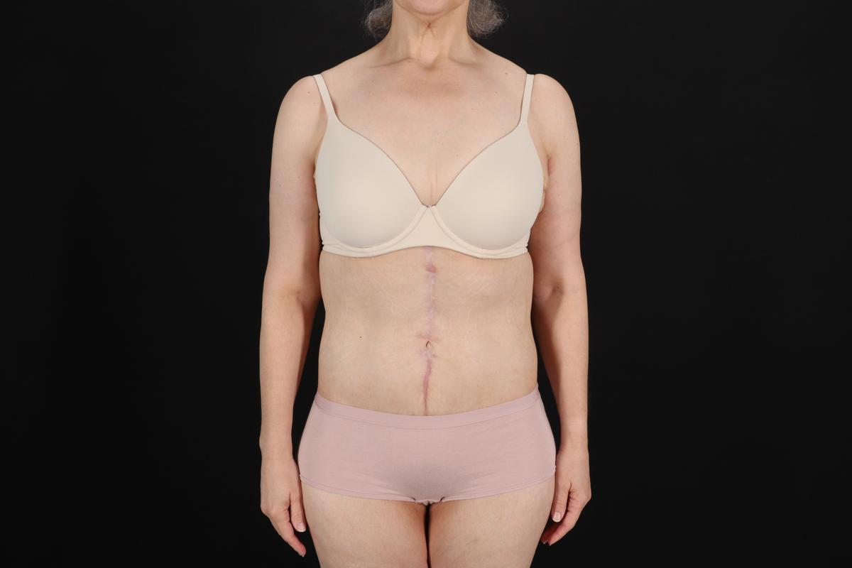 Fleur De Lis Circumferential Body Lift Before & After Patient #9328