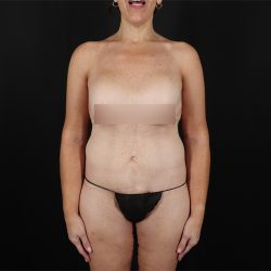 Fleur De Lis Circumferential Body Lift Before & After Patient #9279