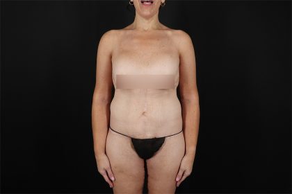 Fleur De Lis Circumferential Body Lift Before & After Patient #9279
