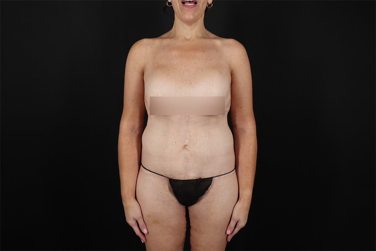 Fleur De Lis Circumferential Body Lift Before & After Patient #9279