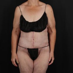 Fleur De Lis Circumferential Body Lift Before & After Patient #9285