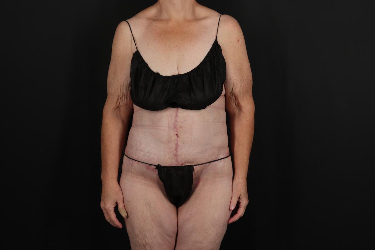 Fleur De Lis Circumferential Body Lift Before & After Patient #9285