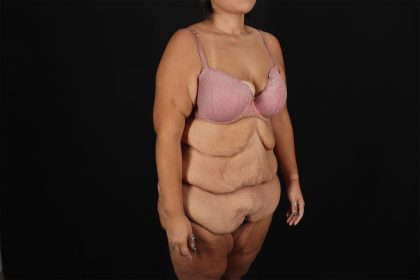Fleur De Lis Tummy Tuck Before & After Patient #9508