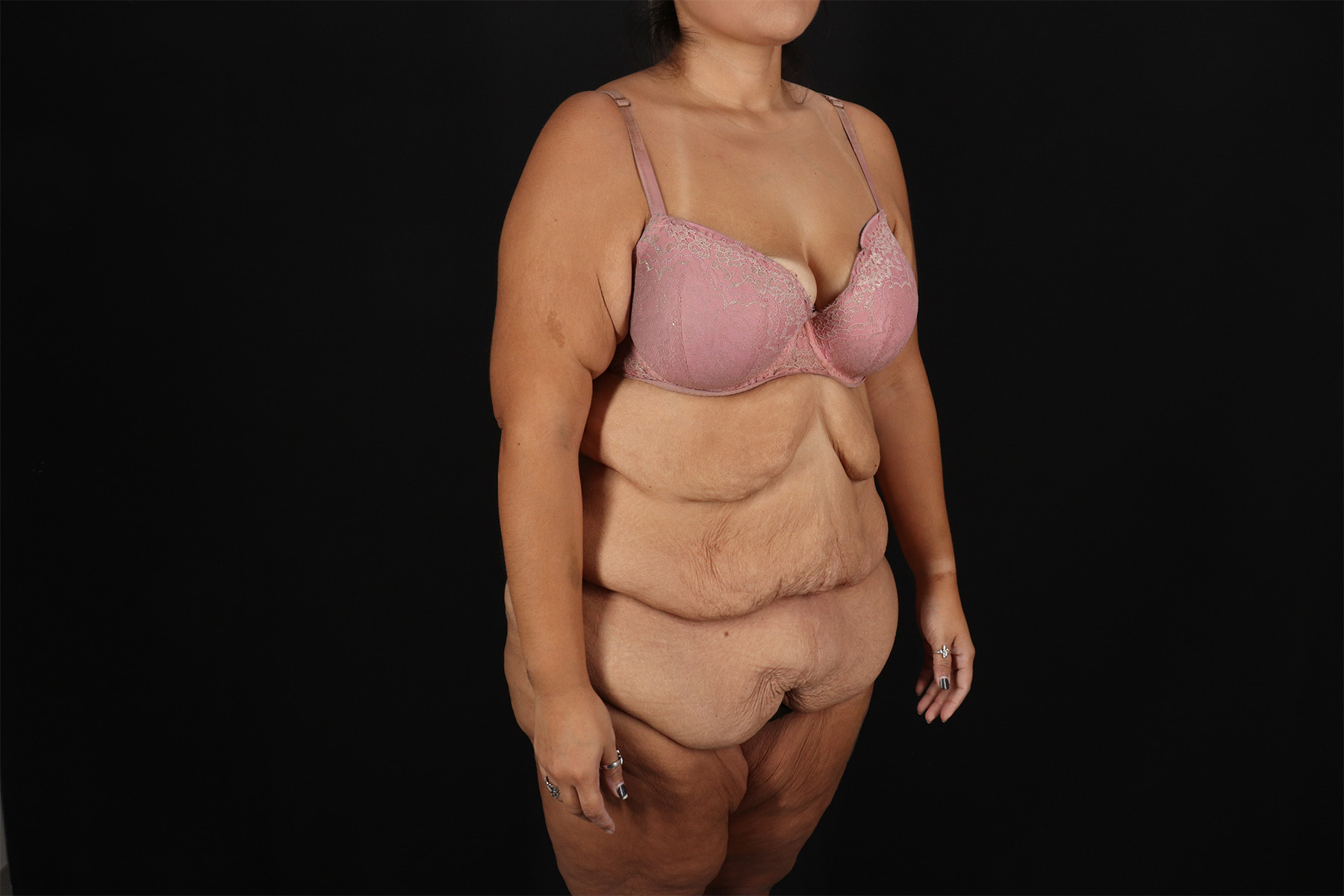 Fleur De Lis Tummy Tuck Before & After Patient #9508