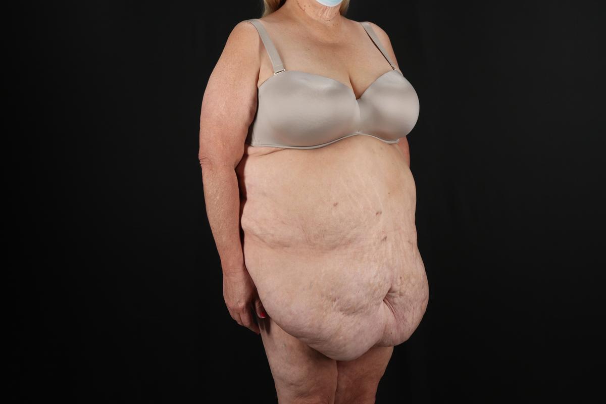 Fleur De Lis Circumferential Body Lift Before & After Patient #9286