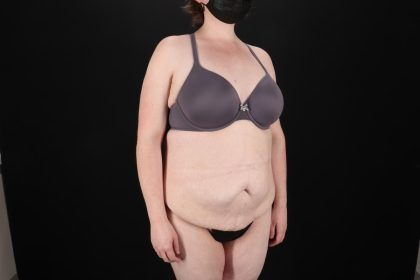Fleur De Lis Tummy Tuck Before & After Patient #9506